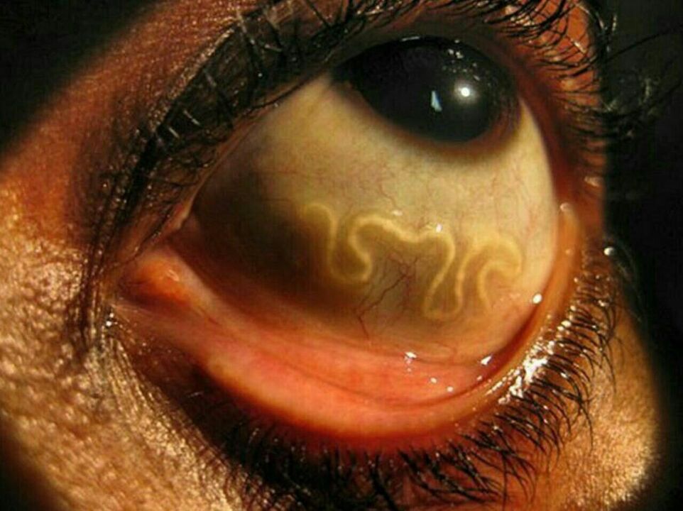 parasites dans l'oeil humain